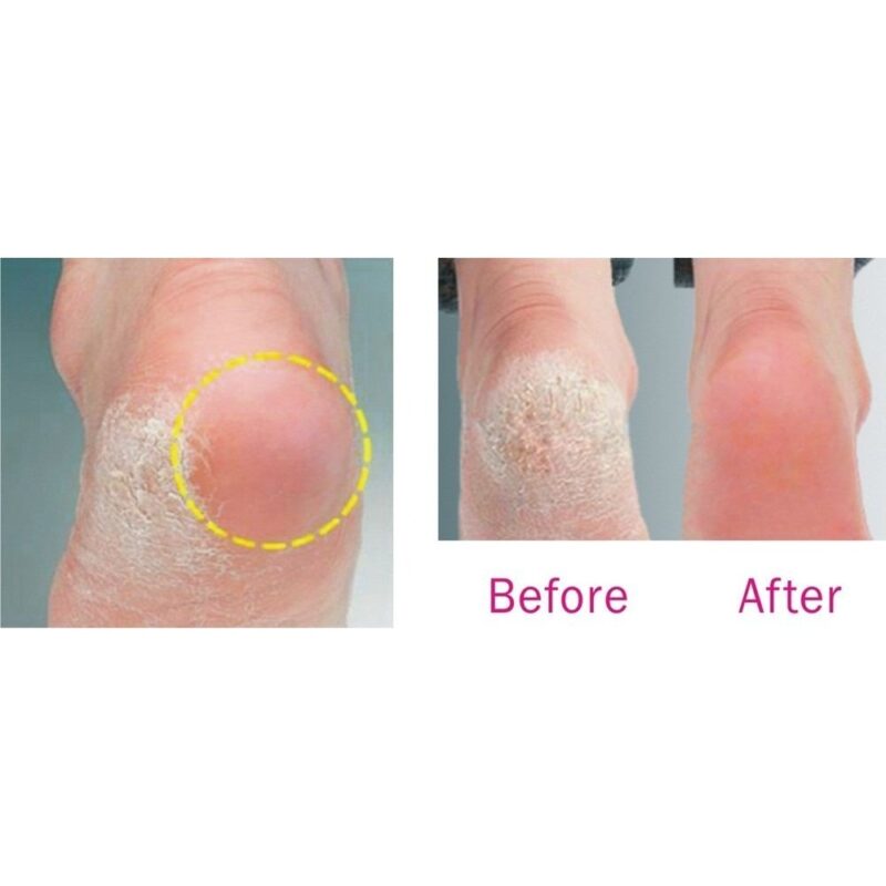Babila Callus Remover (Rechargeable)CR-E01 - Image 4